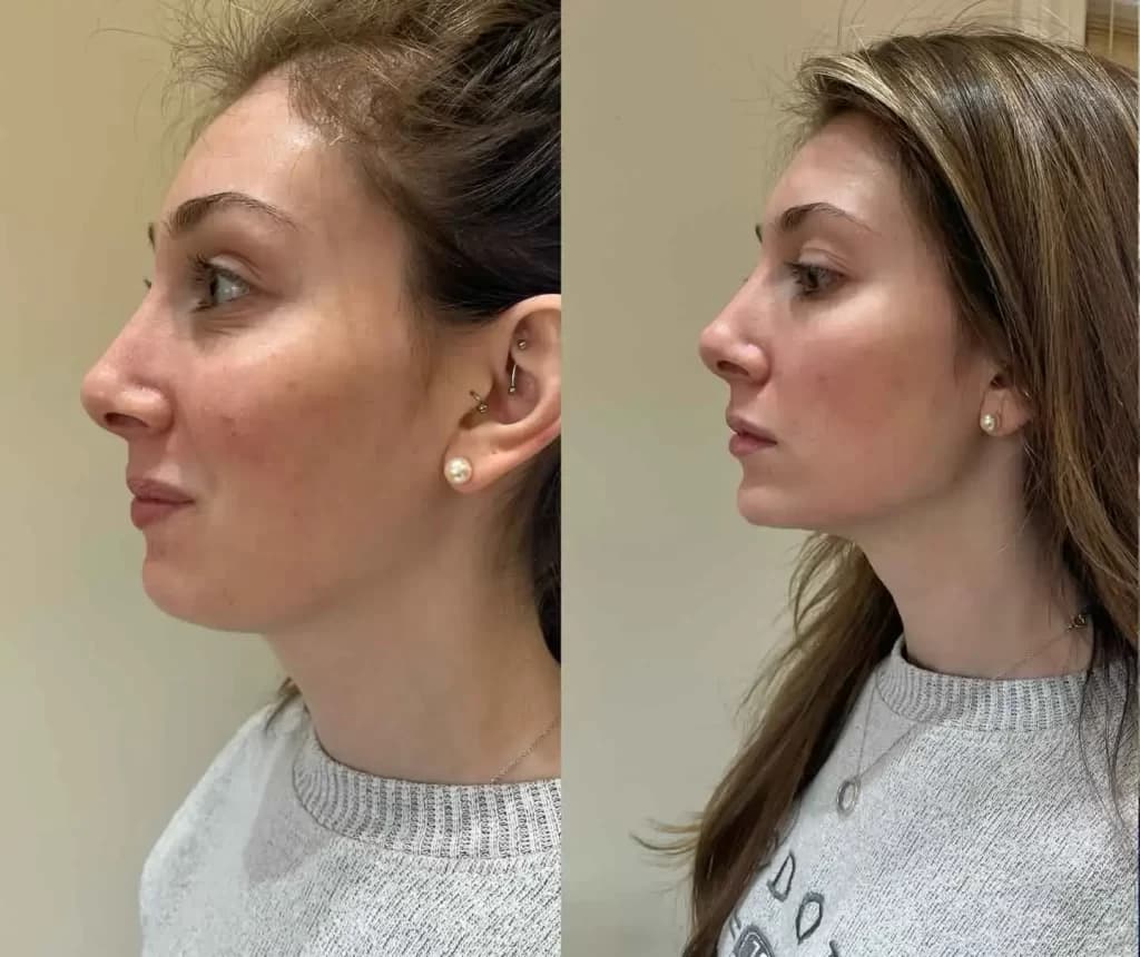 Perfekte Konturen mit dermal fillers jawline – Jetzt verfügbar