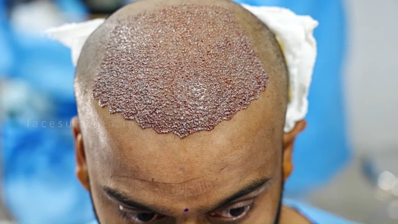 Die Geheimnisse einer erfolgreichen Haartransplantation enthüllen: Ein umfassender Überblick