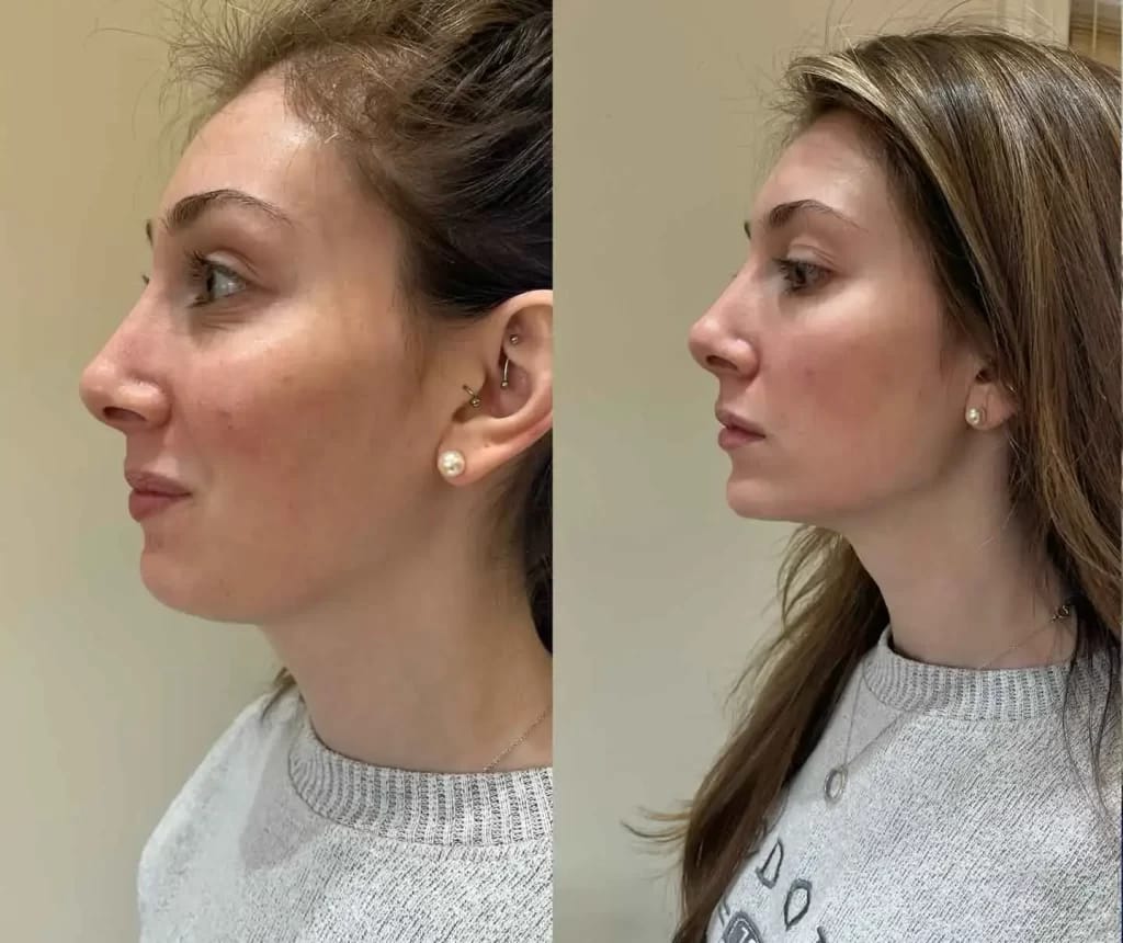 Perfekte Konturen mit dermal fillers jawline – Jetzt verfügbar