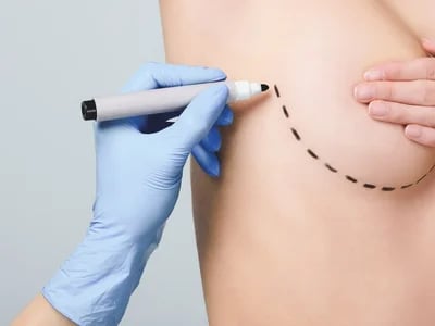 Brustverkleinerung: Ihr erster Schritt zu einem neuen Körpergefühl